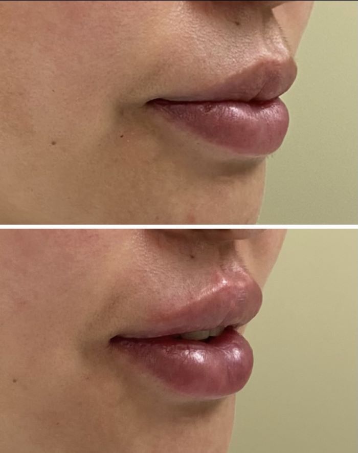 Lip filler before and After Lip filler before and After
