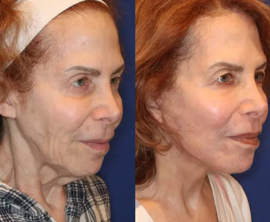 Letybo Results: Real Before and After Stories from Our Medical Cosmetic Practice image for post Letybo Results: Real Before and After Stories from Our Medical Cosmetic Practice