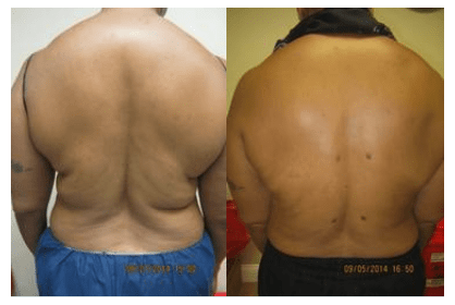 Upper & Lower Back liposuction Drew Varano MD Washington DC Upper & Lower Back liposuction Drew Varano MD Washington DC